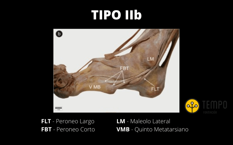 Tipo IIb.png